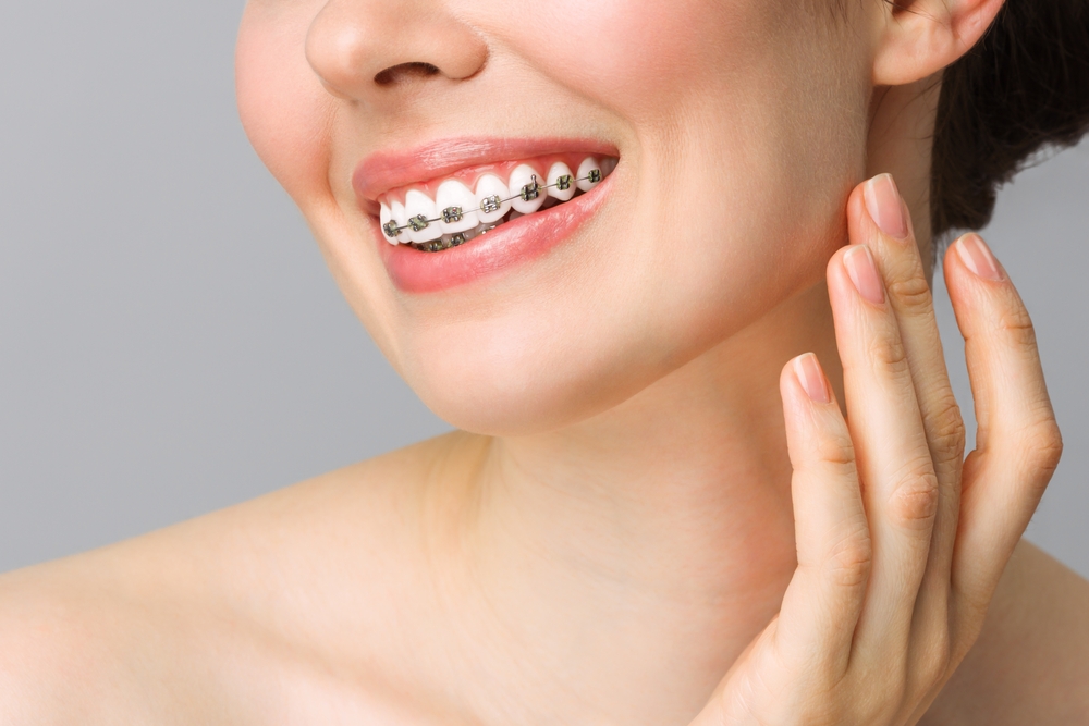 Adult Braces in Tarzana