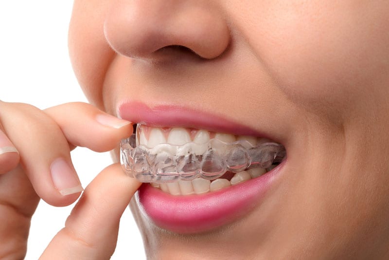 invisalign in toluca lake near me invisalign in toluca lake near me